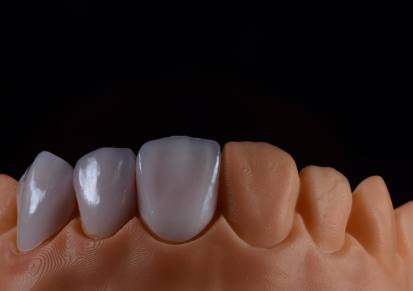 Dental IPS EMax Crown 中国义齿