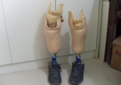 下肢矫形器公司 当涂下肢矫形器 马鞍山德康假肢销售 